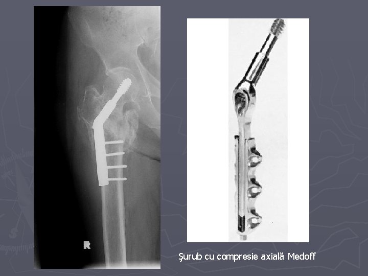 Şurub cu compresie axială Medoff Şurub cu compresie axială Medoff
