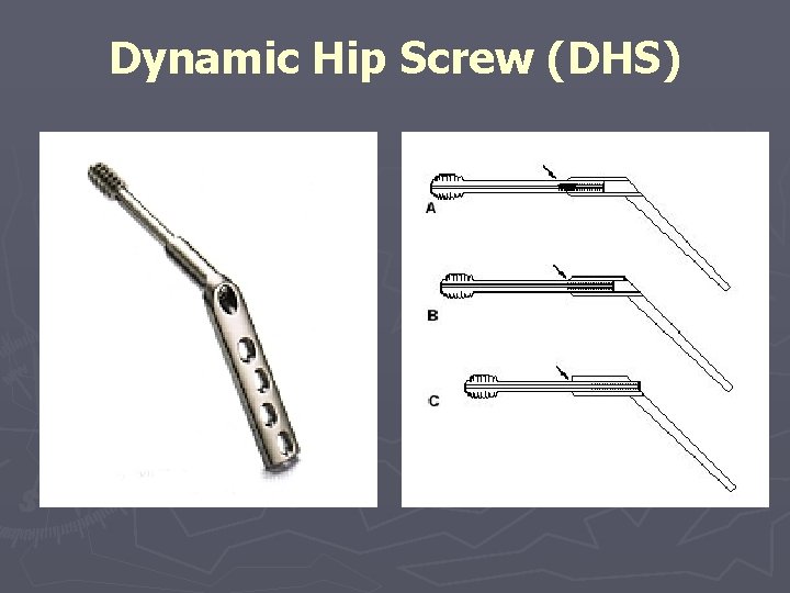 Dynamic Hip Screw (DHS) Dynamic Hip Screw (DHS)
