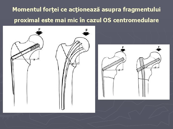 Momentul forţei ce acţionează asupra fragmentului proximal este mai mic în cazul OS centromedulare Momentul forţei ce acţionează asupra fragmentului proximal este mai mic în cazul OS centromedulare