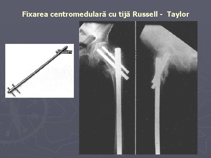 Fixarea centromedulară cu tijă Russell - Taylor Fixarea centromedulară cu tijă Russell - Taylor