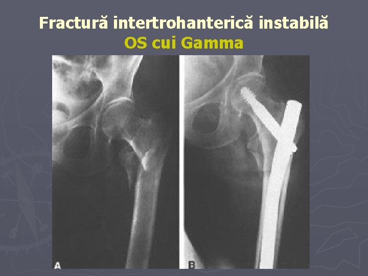 Fractură intertrohanterică instabilă OS cui Gamma Fractură intertrohanterică instabilă OS cui Gamma