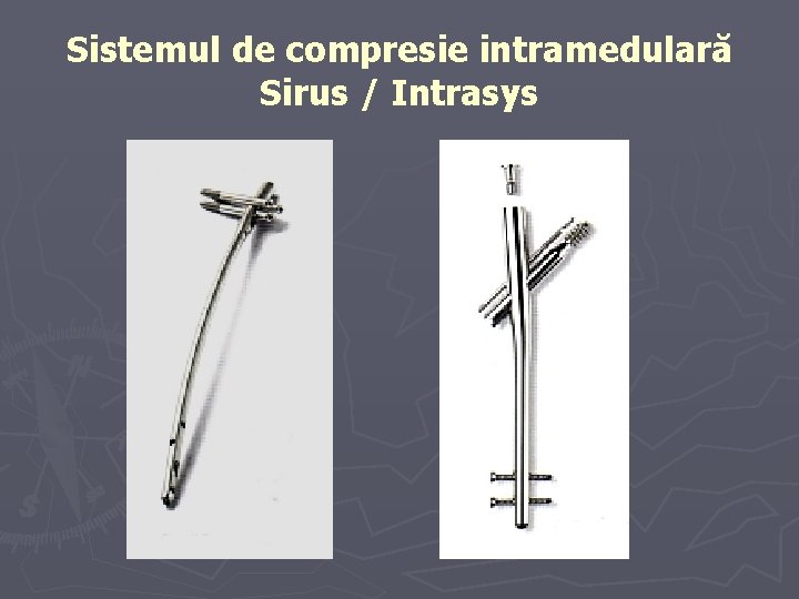 Sistemul de compresie intramedulară Sirus / Intrasys Sistemul de compresie intramedulară Sirus / Intrasys