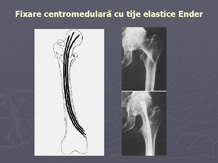 Fixare centromedulară cu tije elastice Ender Fixare centromedulară cu tije elastice Ender
