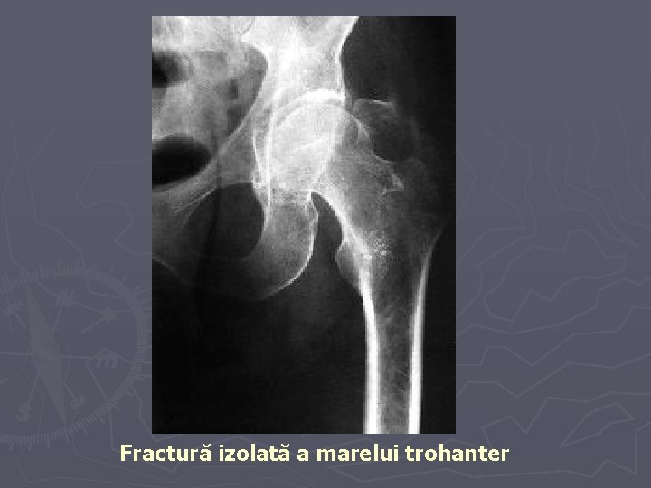 Fractură izolată a marelui trohanter Fractură izolată a marelui trohanter