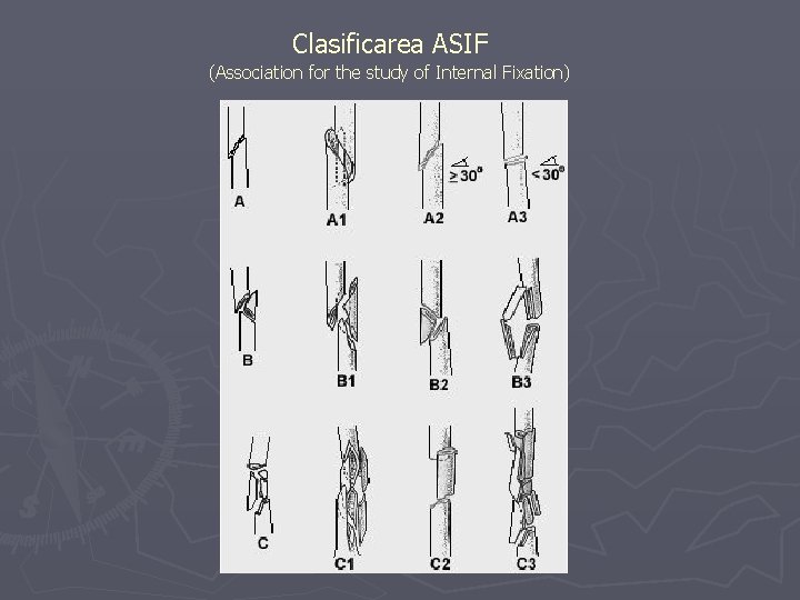 Clasificarea ASIF (Association for the study of Internal Fixation) Clasificarea ASIF (Association for the study of Internal Fixation)