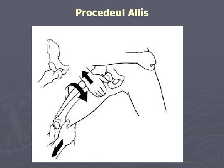 Procedeul Allis Procedeul Allis