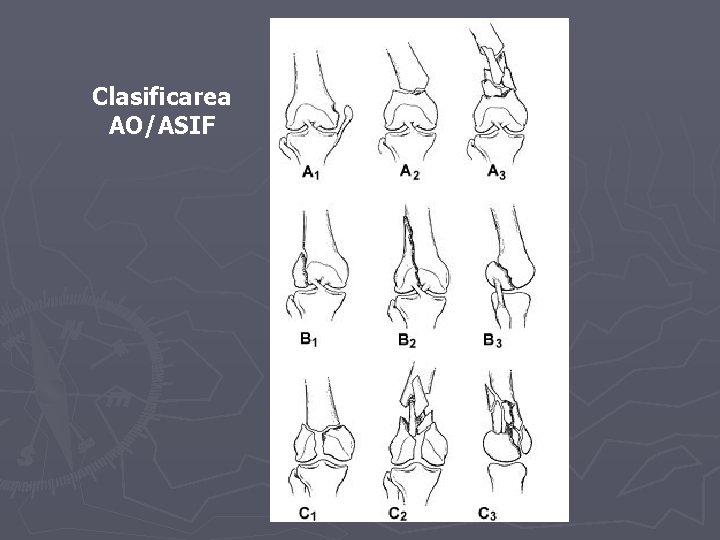 Clasificarea AO/ASIF Clasificarea AO/ASIF