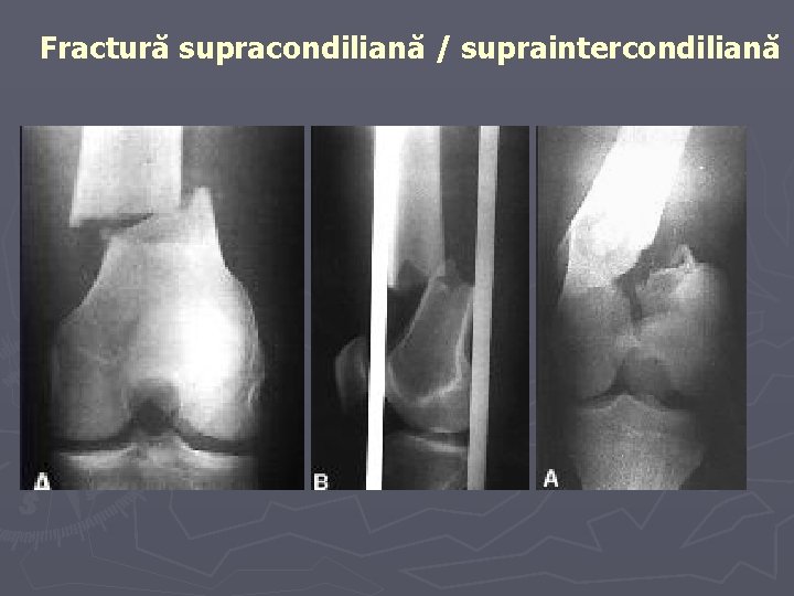 Fractură supracondiliană / supraintercondiliană Fractură supracondiliană / supraintercondiliană