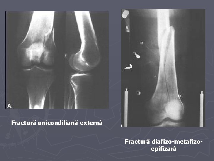 Fractură unicondiliană externă Fractură diafizo-metafizoepifizară Fractură unicondiliană externă Fractură diafizo-metafizoepifizară