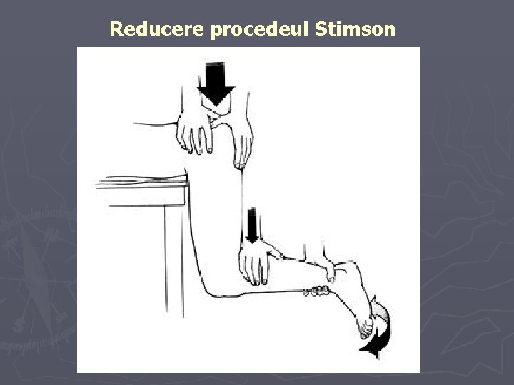 Reducere procedeul Stimson Reducere procedeul Stimson