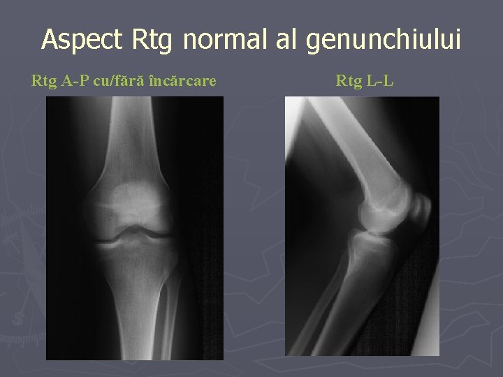 Aspect Rtg normal al genunchiului Rtg A-P cu/fără încărcare Rtg L-L Aspect Rtg normal al genunchiului Rtg A-P cu/fără încărcare Rtg L-L