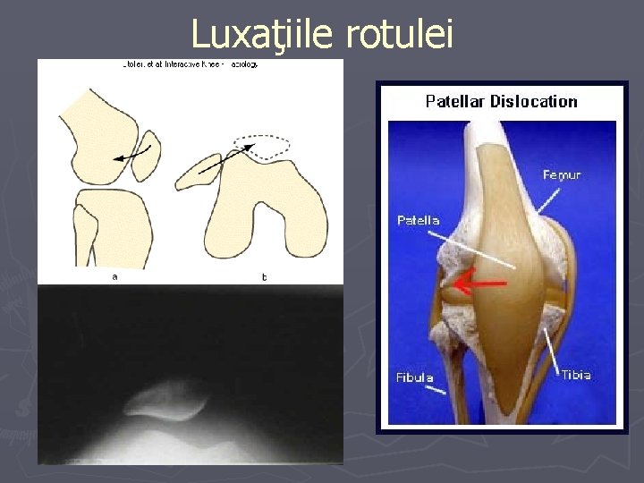 Luxaţiile rotulei Luxaţiile rotulei