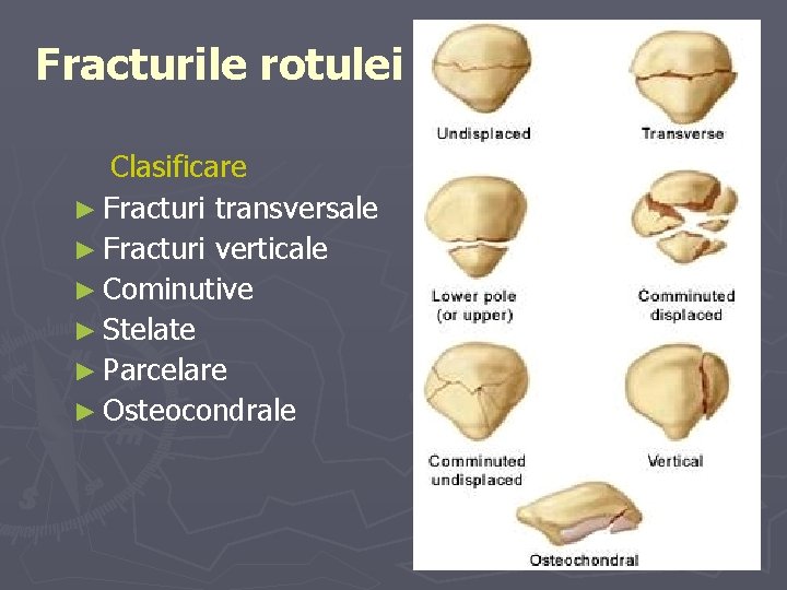 Fracturile rotulei Clasificare ► Fracturi transversale ► Fracturi verticale ► Cominutive ► Stelate ► Fracturile rotulei Clasificare ► Fracturi transversale ► Fracturi verticale ► Cominutive ► Stelate ►