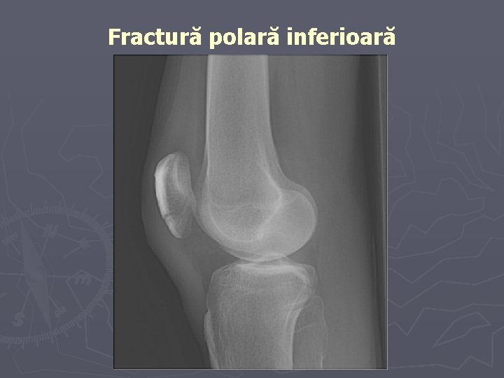 Fractură polară inferioară Fractură polară inferioară