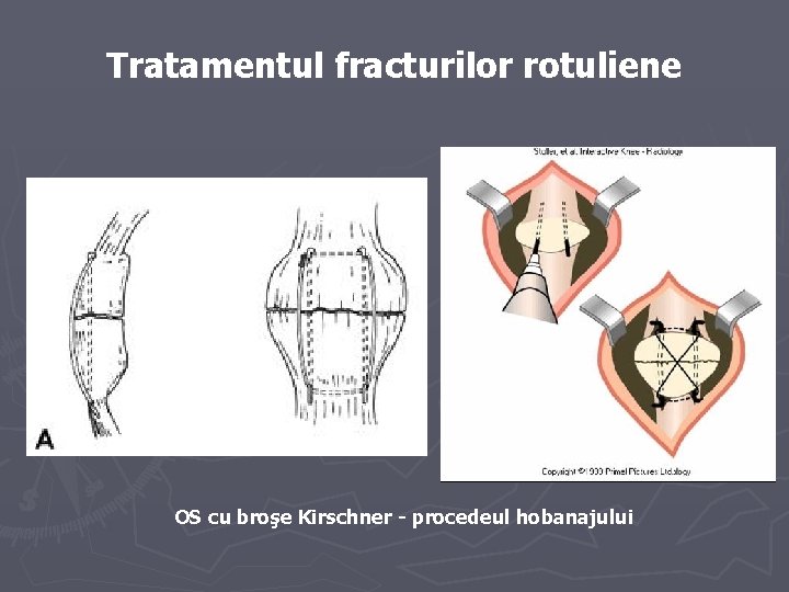 Tratamentul fracturilor rotuliene OS cu broşe Kirschner - procedeul hobanajului Tratamentul fracturilor rotuliene OS cu broşe Kirschner - procedeul hobanajului