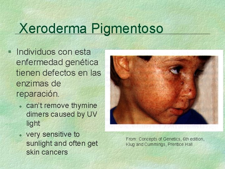Xeroderma Pigmentoso § Individuos con esta enfermedad genética tienen defectos en las enzimas de Xeroderma Pigmentoso § Individuos con esta enfermedad genética tienen defectos en las enzimas de