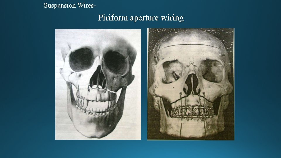 Suspension Wires- Piriform aperture wiring 