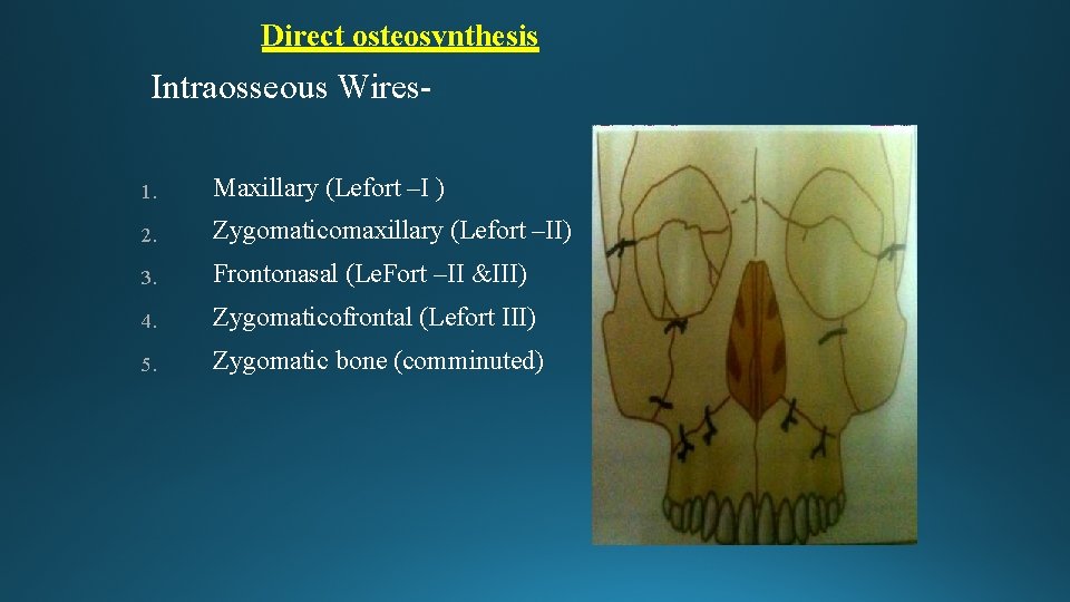 Direct osteosynthesis Intraosseous Wires 1. Maxillary (Lefort –I ) 2. Zygomaticomaxillary (Lefort –II) 3.