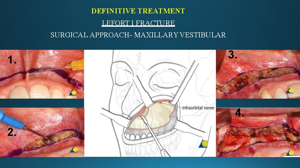 DEFINITIVE TREATMENT LEFORT I FRACTURE SURGICAL APPROACH- MAXILLARY VESTIBULAR 1. 3. 4. 2. 