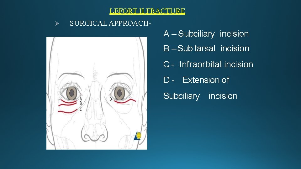 LEFORT II FRACTURE SURGICAL APPROACH- A – Subciliary incision B – Sub tarsal incision