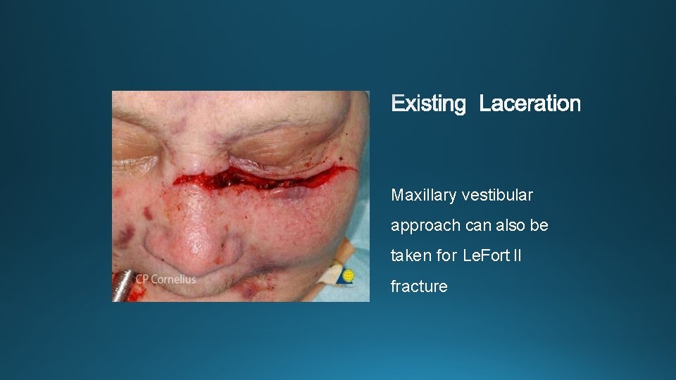 Maxillary vestibular approach can also be taken for Le. Fort II fracture 