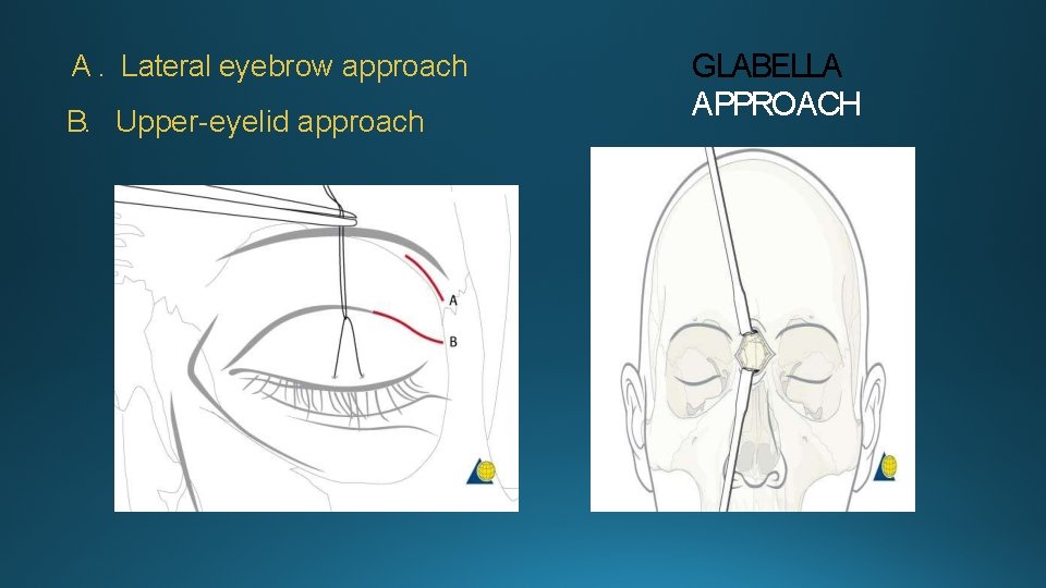 A. Lateral eyebrow approach B. Upper-eyelid approach GLABELLA APPROACH 