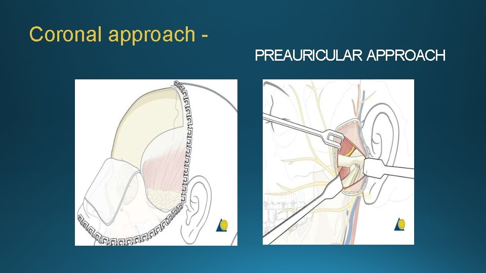 Coronal approach PREAURICULAR APPROACH 