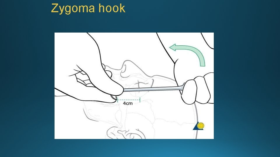 Zygoma hook 