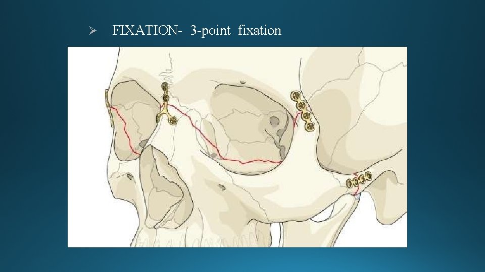  FIXATION- 3 -point fixation 