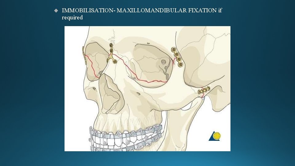  IMMOBILISATION- MAXILLOMANDIBULAR FIXATION if required 