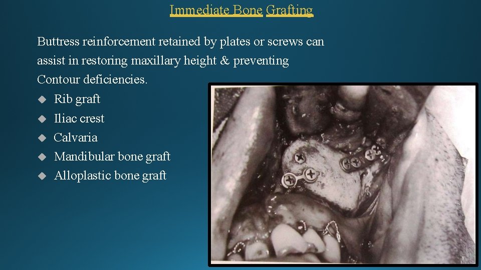 Immediate Bone Grafting Buttress reinforcement retained by plates or screws can assist in restoring