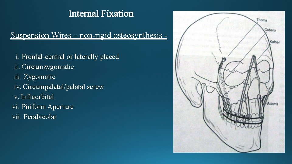 Suspension Wires – non-rigid osteosynthesis i. Frontal-central or laterally placed ii. Circumzygomatic iii. Zygomatic