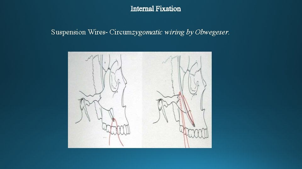 Suspension Wires- Circumzygomatic wiring by Obwegeser. 