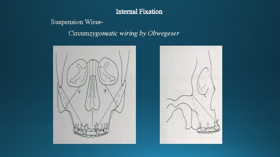 Suspension Wires. Circumzygomatic wiring by Obwegeser 