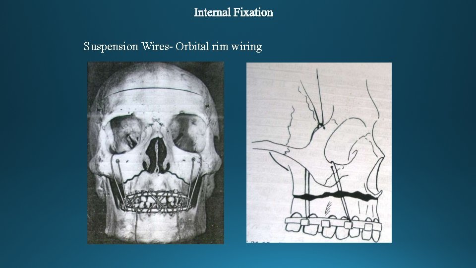 Suspension Wires- Orbital rim wiring 