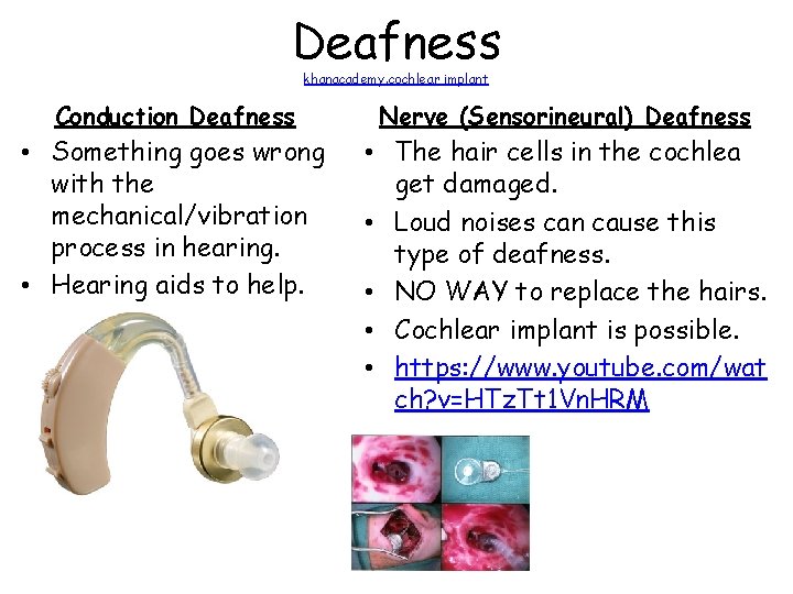 Deafness khanacademy. cochlear implant Conduction Deafness Nerve (Sensorineural) Deafness • Something goes wrong with Deafness khanacademy. cochlear implant Conduction Deafness Nerve (Sensorineural) Deafness • Something goes wrong with