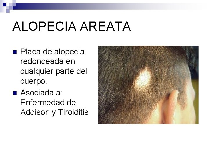 ALOPECIA AREATA n n Placa de alopecia redondeada en cualquier parte del cuerpo. Asociada