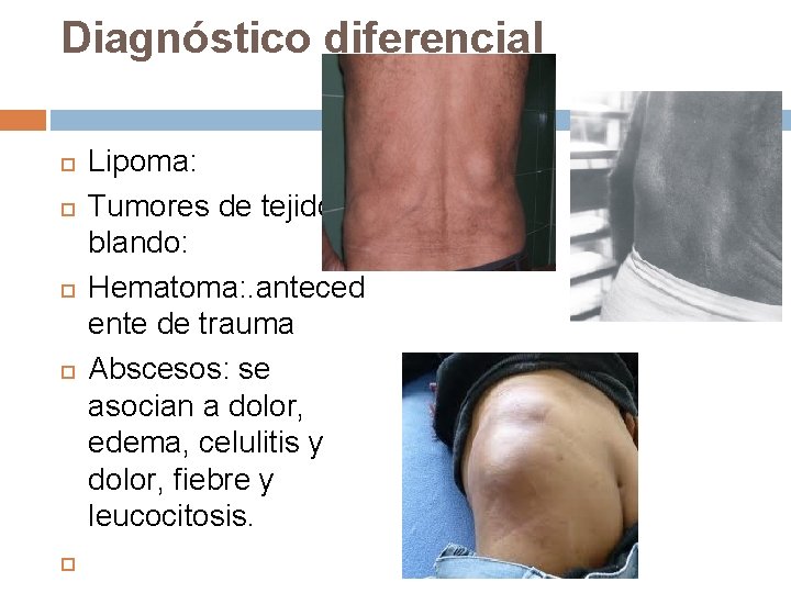 Diagnóstico diferencial Lipoma: Tumores de tejido blando: Hematoma: . anteced ente de trauma Abscesos: