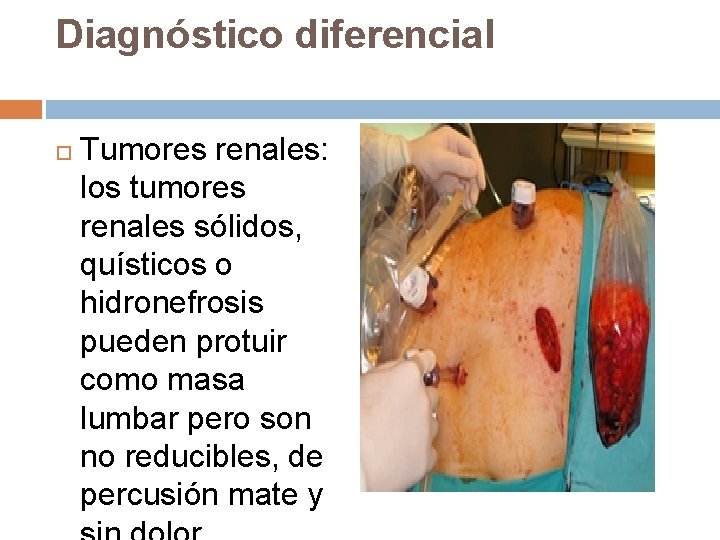 Diagnóstico diferencial Tumores renales: los tumores renales sólidos, quísticos o hidronefrosis pueden protuir como