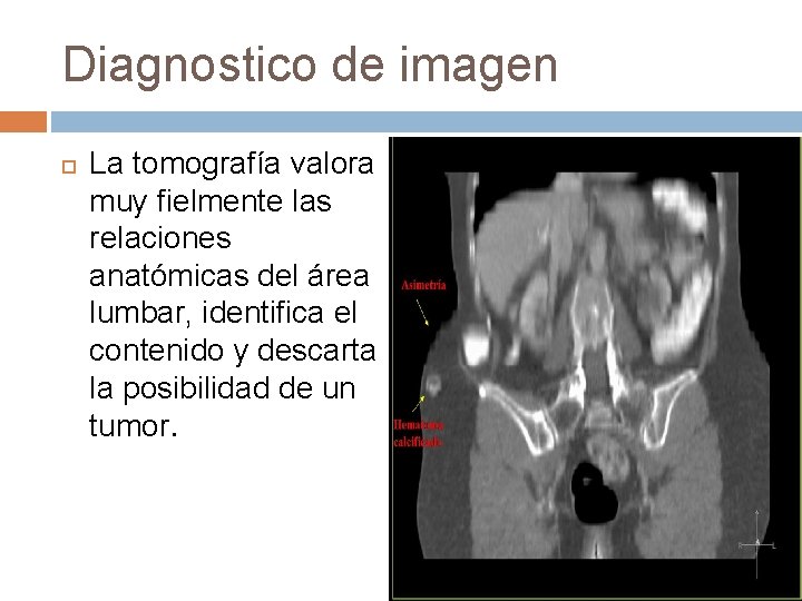 Diagnostico de imagen La tomografía valora muy fielmente las relaciones anatómicas del área lumbar,