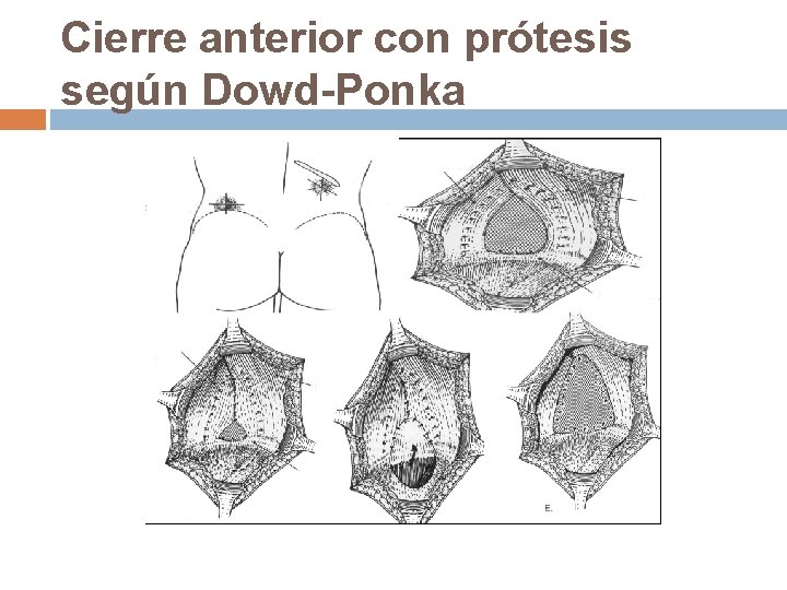 Cierre anterior con prótesis según Dowd-Ponka 