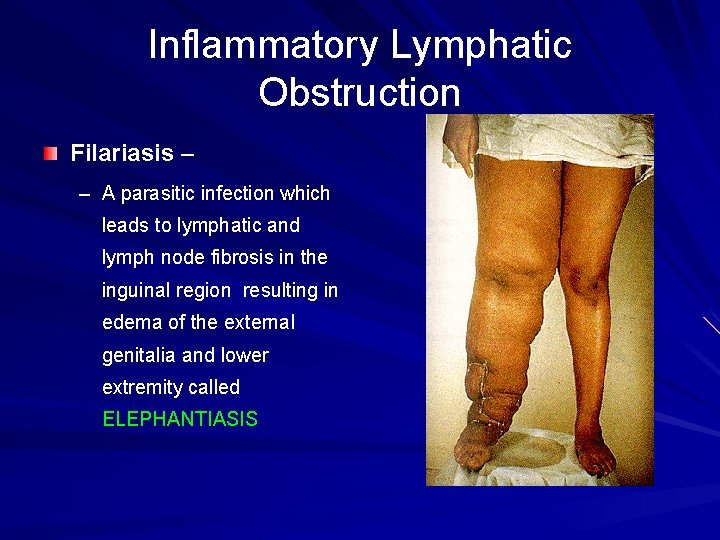 Inflammatory Lymphatic Obstruction Filariasis – – A parasitic infection which leads to lymphatic and Inflammatory Lymphatic Obstruction Filariasis – – A parasitic infection which leads to lymphatic and