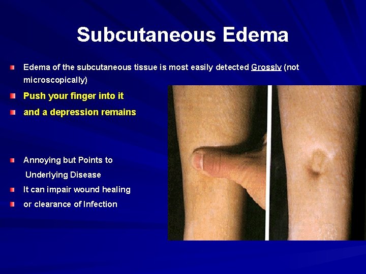 Subcutaneous Edema of the subcutaneous tissue is most easily detected Grossly (not microscopically) Push Subcutaneous Edema of the subcutaneous tissue is most easily detected Grossly (not microscopically) Push