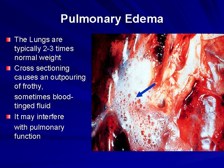 Pulmonary Edema The Lungs are typically 2 -3 times normal weight Cross sectioning causes Pulmonary Edema The Lungs are typically 2 -3 times normal weight Cross sectioning causes