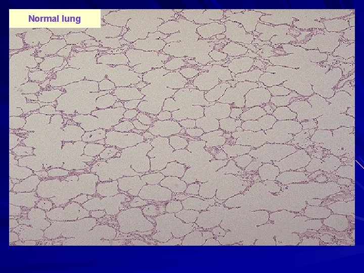 Normal lung Normal lung