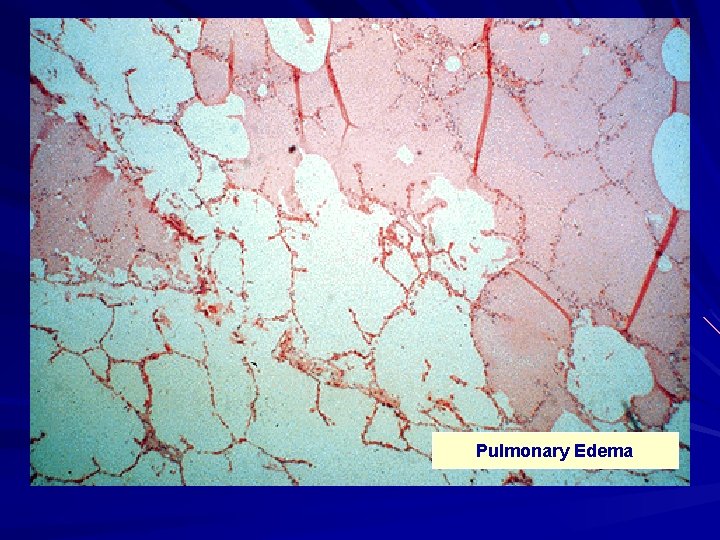 Pulmonary Edema Pulmonary Edema