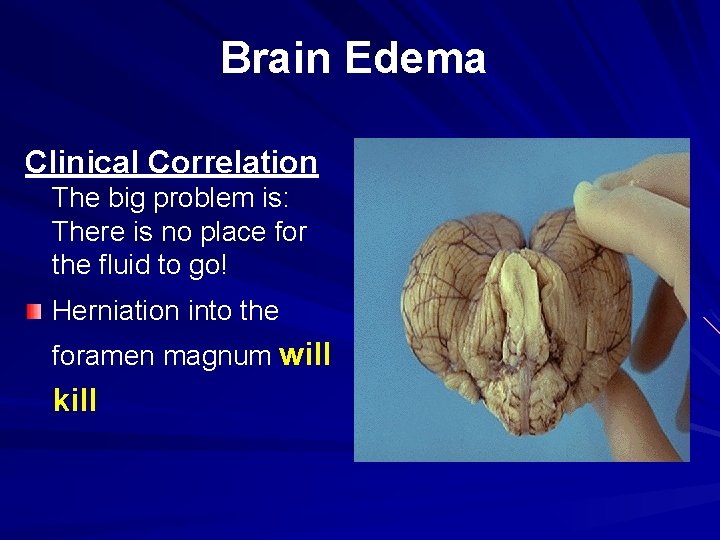 Brain Edema Clinical Correlation The big problem is: There is no place for the Brain Edema Clinical Correlation The big problem is: There is no place for the