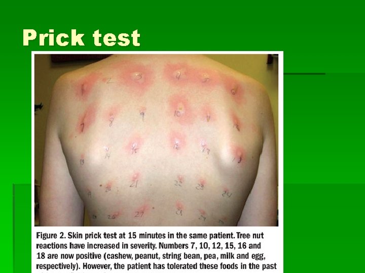 Prick test 