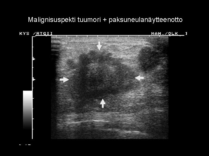 Malignisuspekti tuumori + paksuneulanäytteenotto 