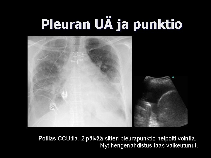 Pleuran UÄ ja punktio Potilas CCU: lla. 2 päivää sitten pleurapunktio helpotti vointia. Nyt